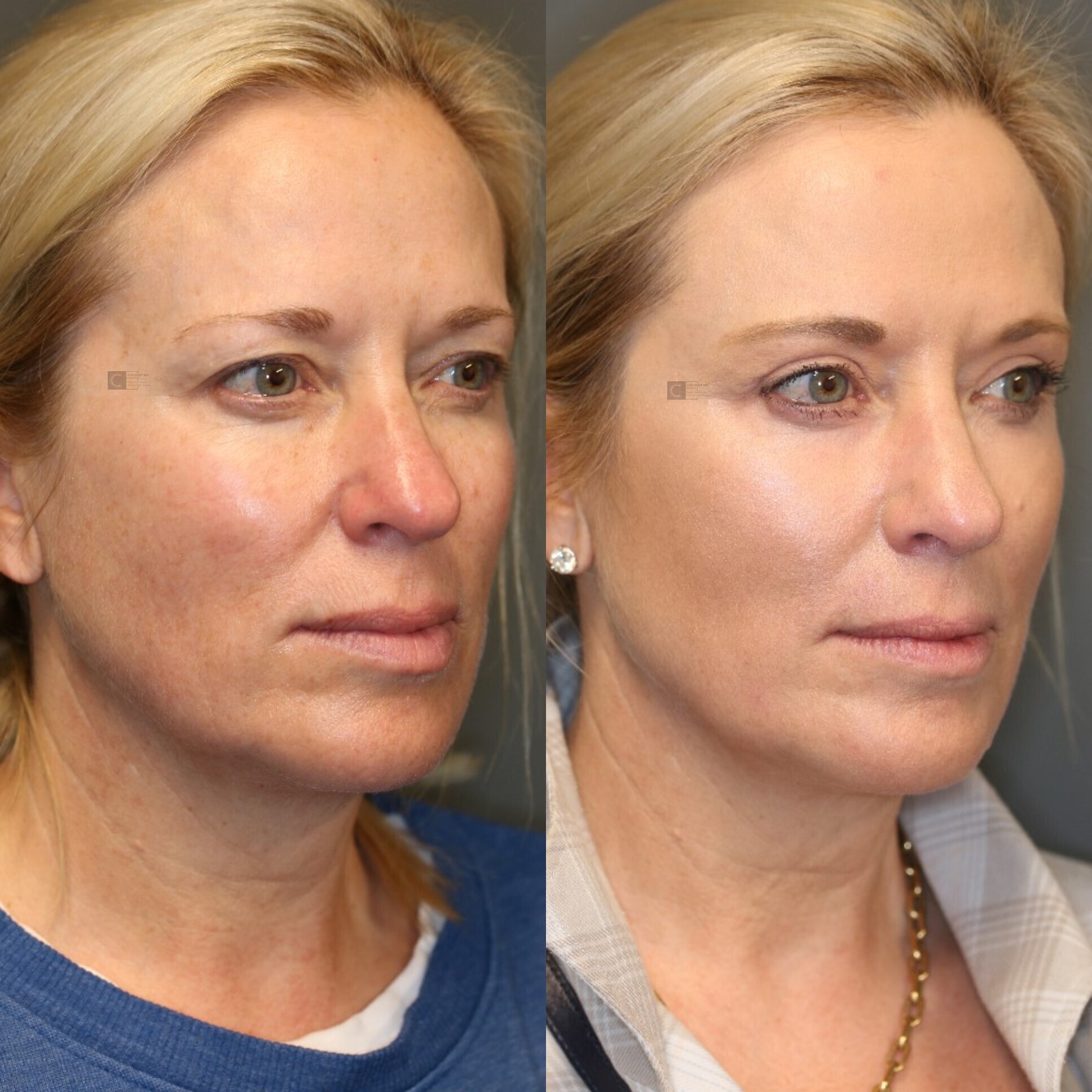 Facial Fat Transfer Spokane Clinic 5C