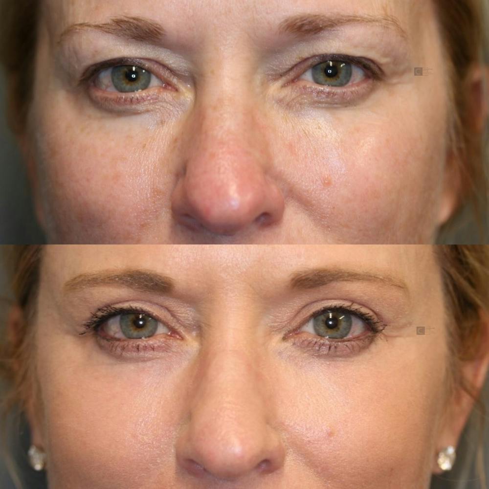 EnigmaLift - Brow Lift Before & After Gallery - Patient 114700406 - Image 3