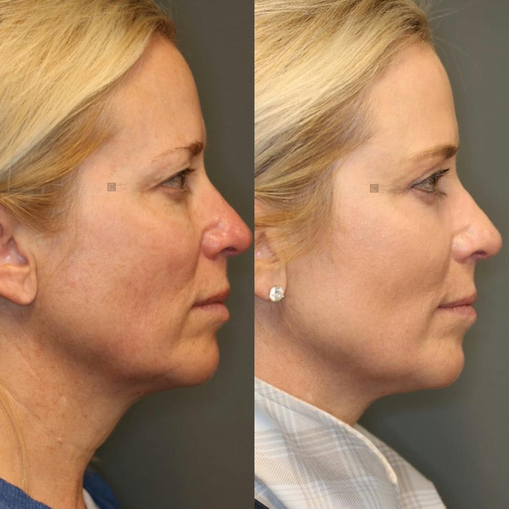 ÔPTIMized Laser Cocktail Before & After Gallery - Patient 114700420 - Image 4