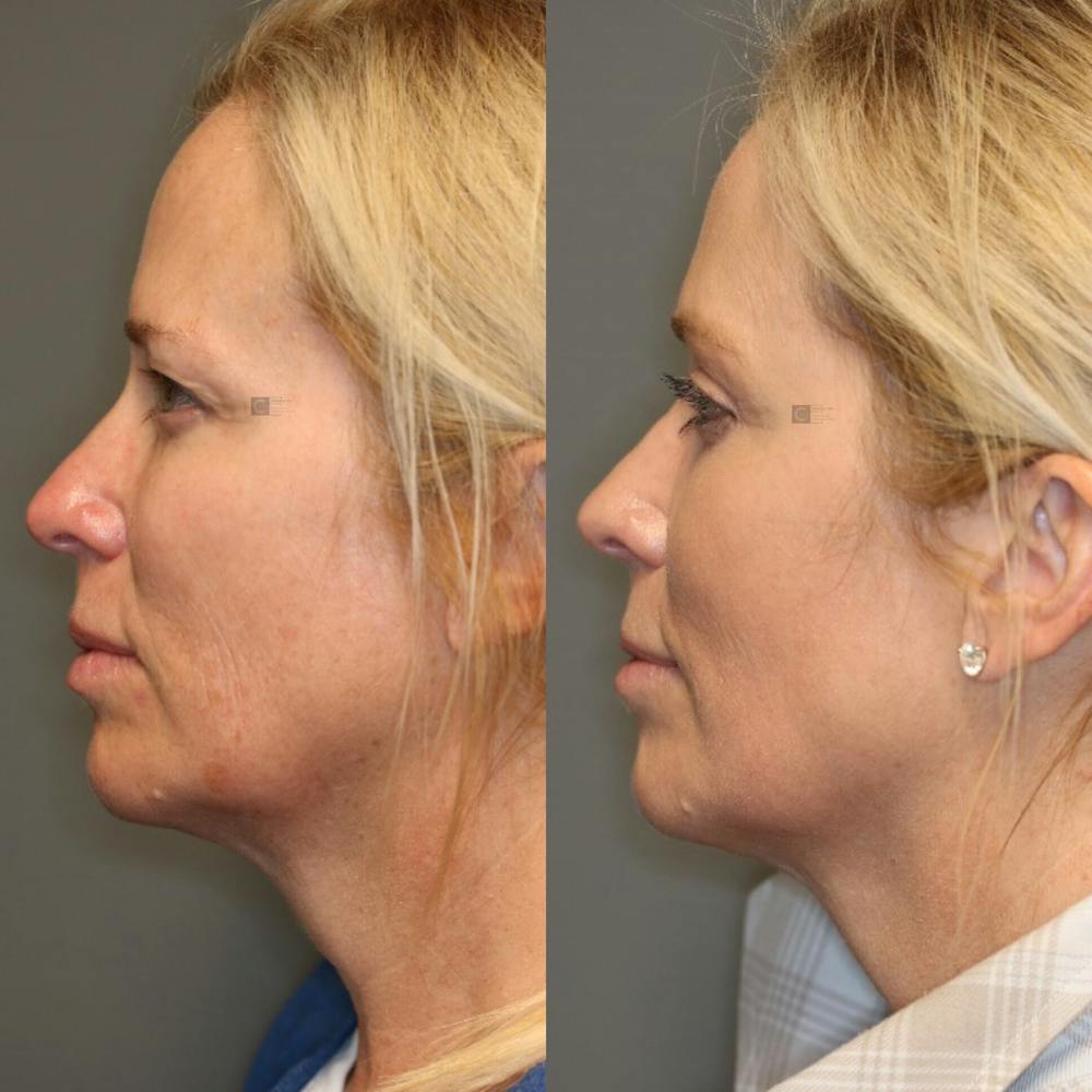 ÔPTIMized Laser Cocktail Before & After Gallery - Patient 114700420 - Image 5