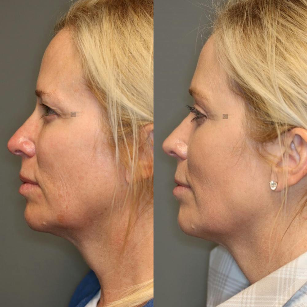 Regenerative Medicine Before & After Gallery - Patient 114700427 - Image 5