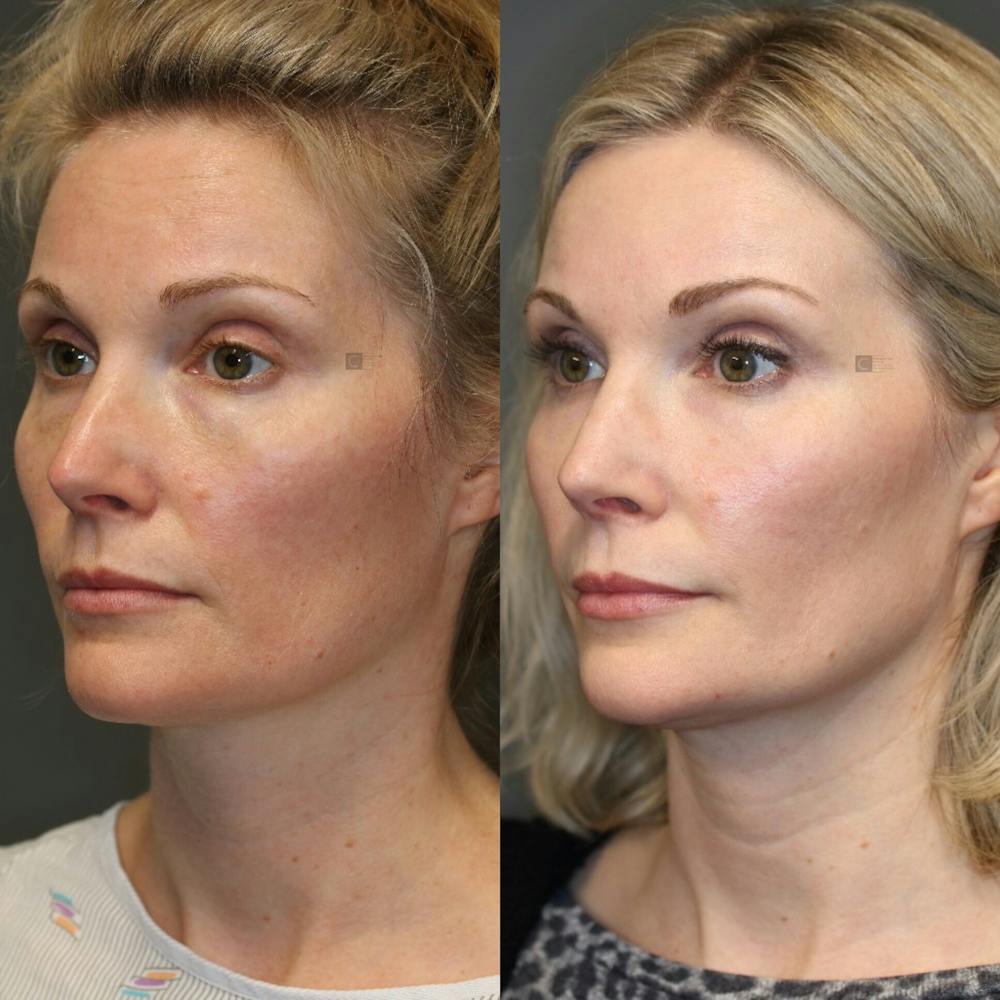 ÔPTIMized Facial Fat Transfer Before & After Gallery - Patient 114700446 - Image 1