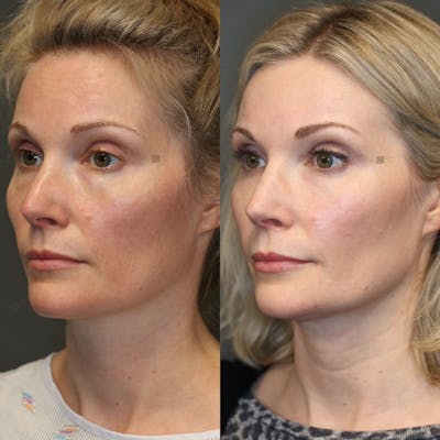 ÔPTIMized Facial Fat Transfer Before & After Gallery - Patient 114700446 - Image 1