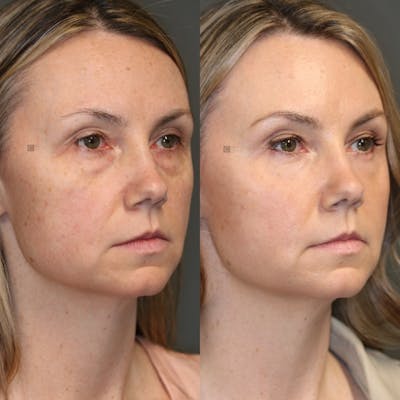 Before & After EnimaLift Eye Bag Removal