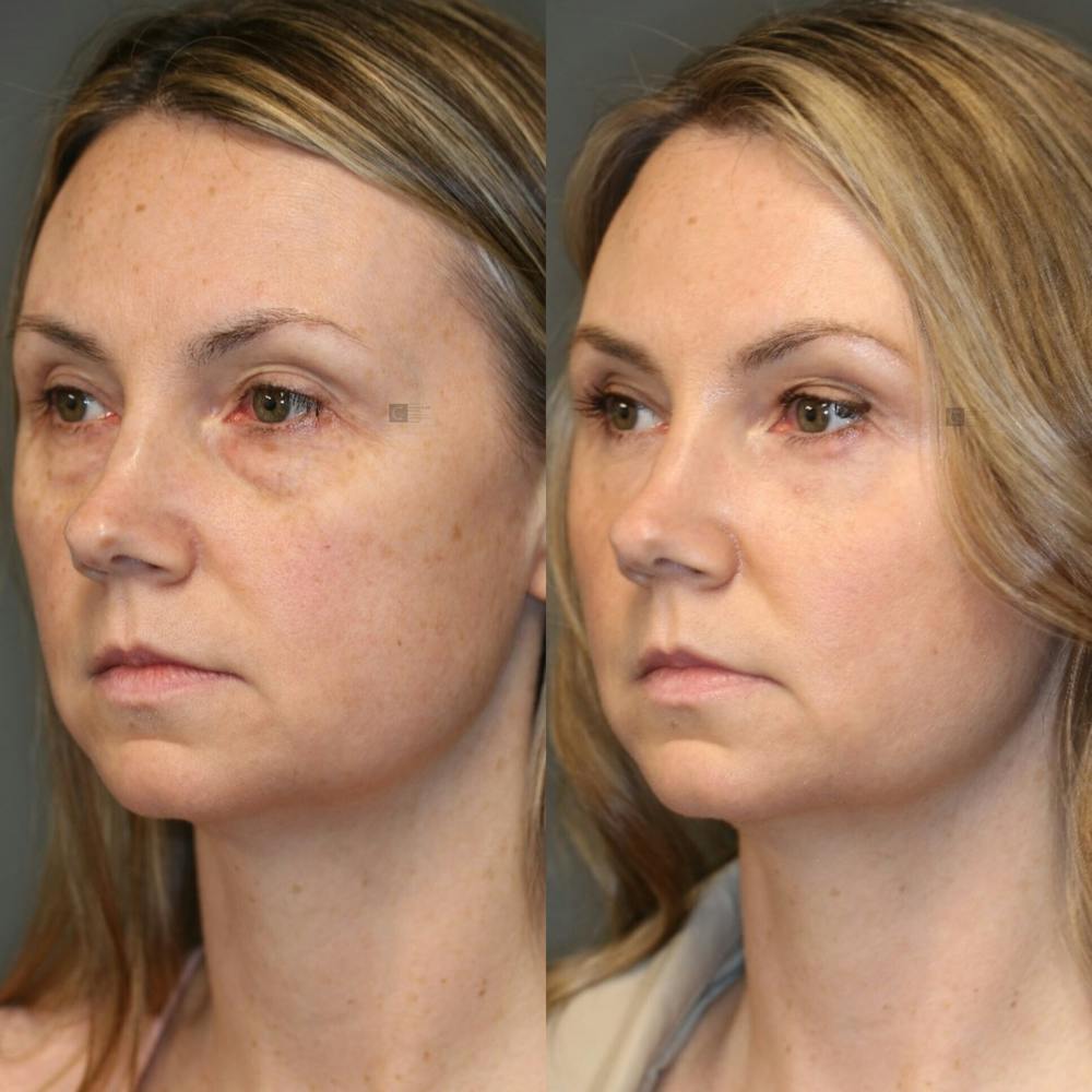 ÔPTIMized Laser Cocktail Before & After Gallery - Patient 114700468 - Image 2
