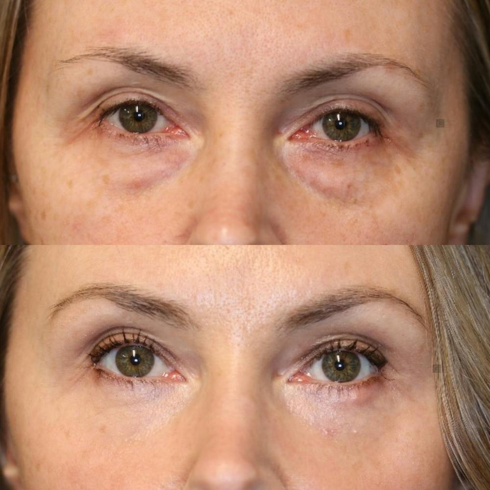 ÔPTIMized Laser Cocktail Before & After Gallery - Patient 114700468 - Image 3