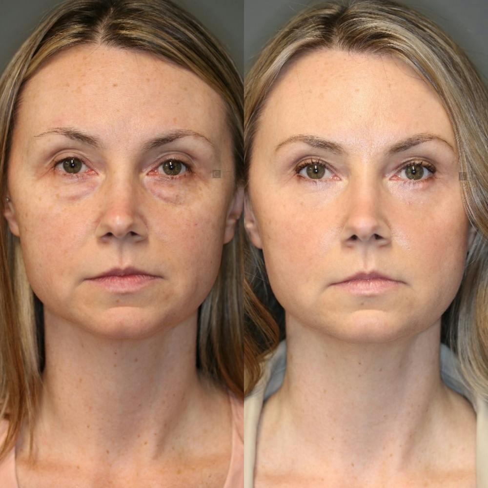 EnigmaLift - Eye Bag Removal Before & After Gallery - Patient 114700470 - Image 4