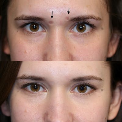 Regenerative Medicine Before & After Gallery - Patient 114700474 - Image 2