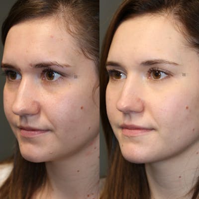Scar Treatment Before & After Gallery - Patient 114700475 - Image 1