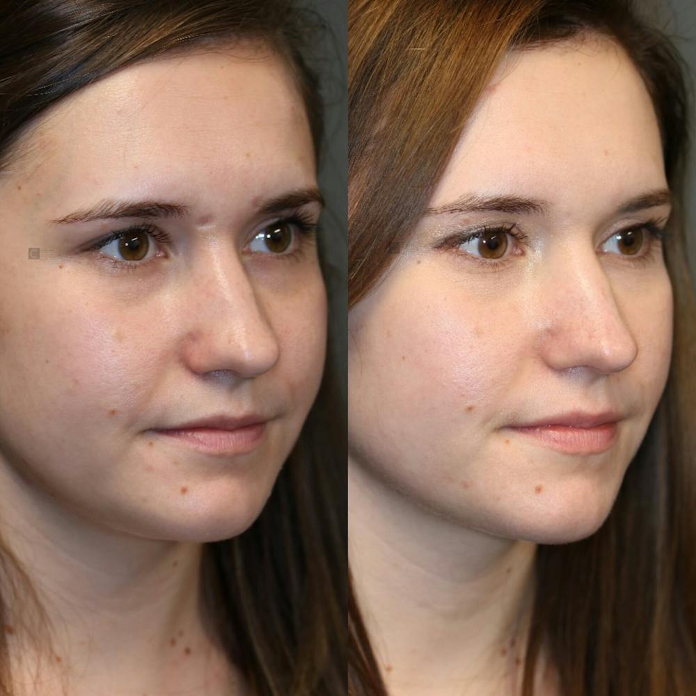 Scar Treatment Before & After Gallery - Patient 114700475 - Image 3