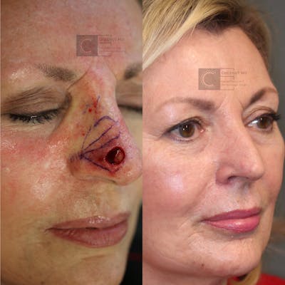MOHS & Reconstruction Surgery Before & After Gallery - Patient 114700478 - Image 1