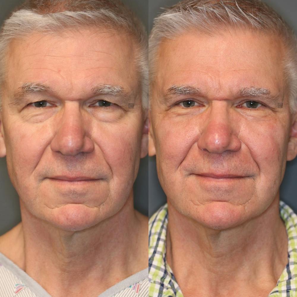 ÔPTIMized Facial Fat Transfer Before & After Gallery - Patient 114700528 - Image 1