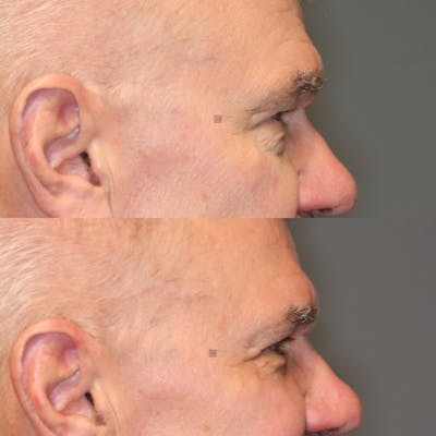 ÔPTIMized Facial Fat Transfer Before & After Gallery - Patient 114700528 - Image 2