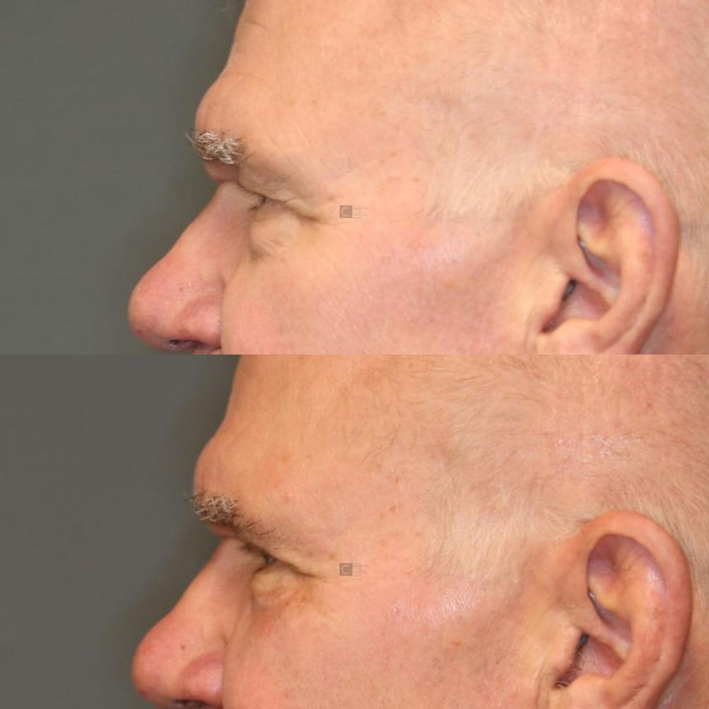 ÔPTIMized Facial Fat Transfer Before & After Gallery - Patient 114700528 - Image 4