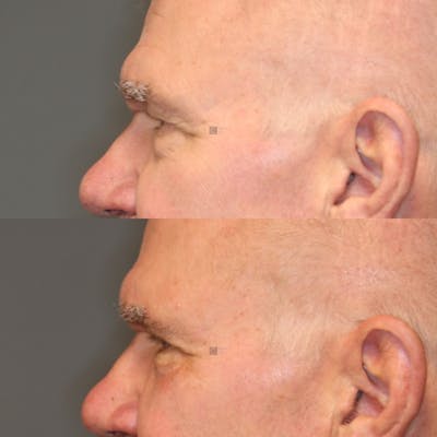 ÔPTIMized Facial Fat Transfer Before & After Gallery - Patient 114700528 - Image 4