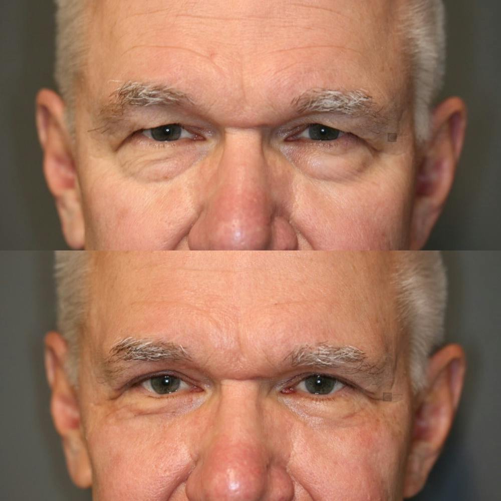 EnigmaLift - Eye Bag Removal Before & After Gallery - Patient 114700523 - Image 5