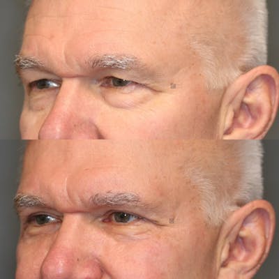 ÔPTIMized Laser Cocktail Before & After Gallery - Patient 114700530 - Image 6