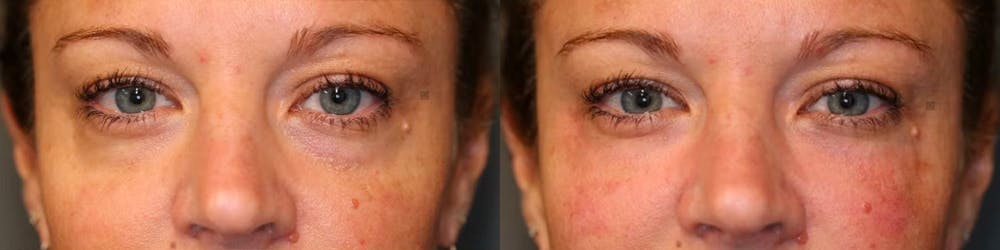 EnigmaLift - Eye Bag Removal Before & After Gallery - Patient 114700559 - Image 1