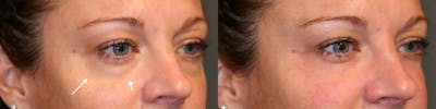 Dermal Fillers Before & After Gallery - Patient 114700556 - Image 2