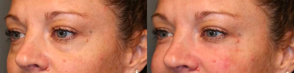 EnigmaLift - Eye Bag Removal Before & After Gallery - Patient 114700559 - Image 3