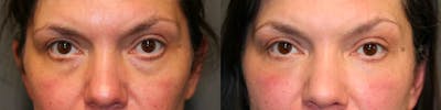 Facial Fat Transfer Before & After Gallery - Patient 114700501 - Image 1