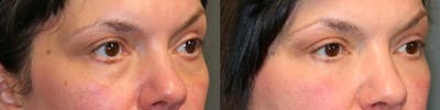 EnigmaLift - Eye Bag Removal Before & After Gallery - Patient 114700500 - Image 2