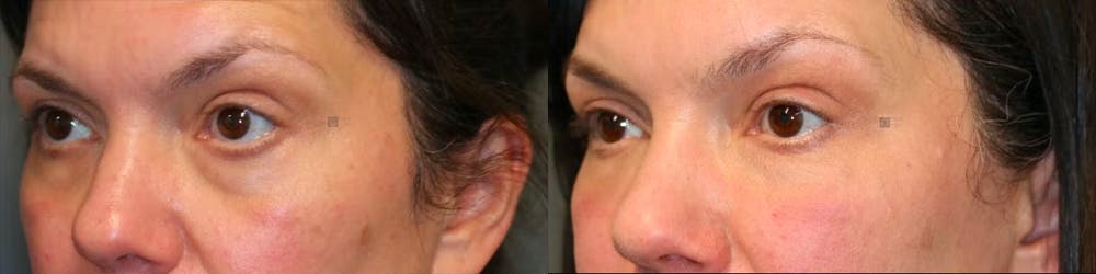 EnigmaLift - Eye Bag Removal Before & After Gallery - Patient 114700500 - Image 3