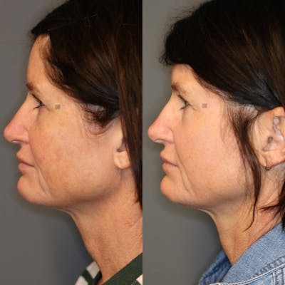 ÔPTIMized Laser Cocktail Before & After Gallery - Patient 116727569 - Image 1