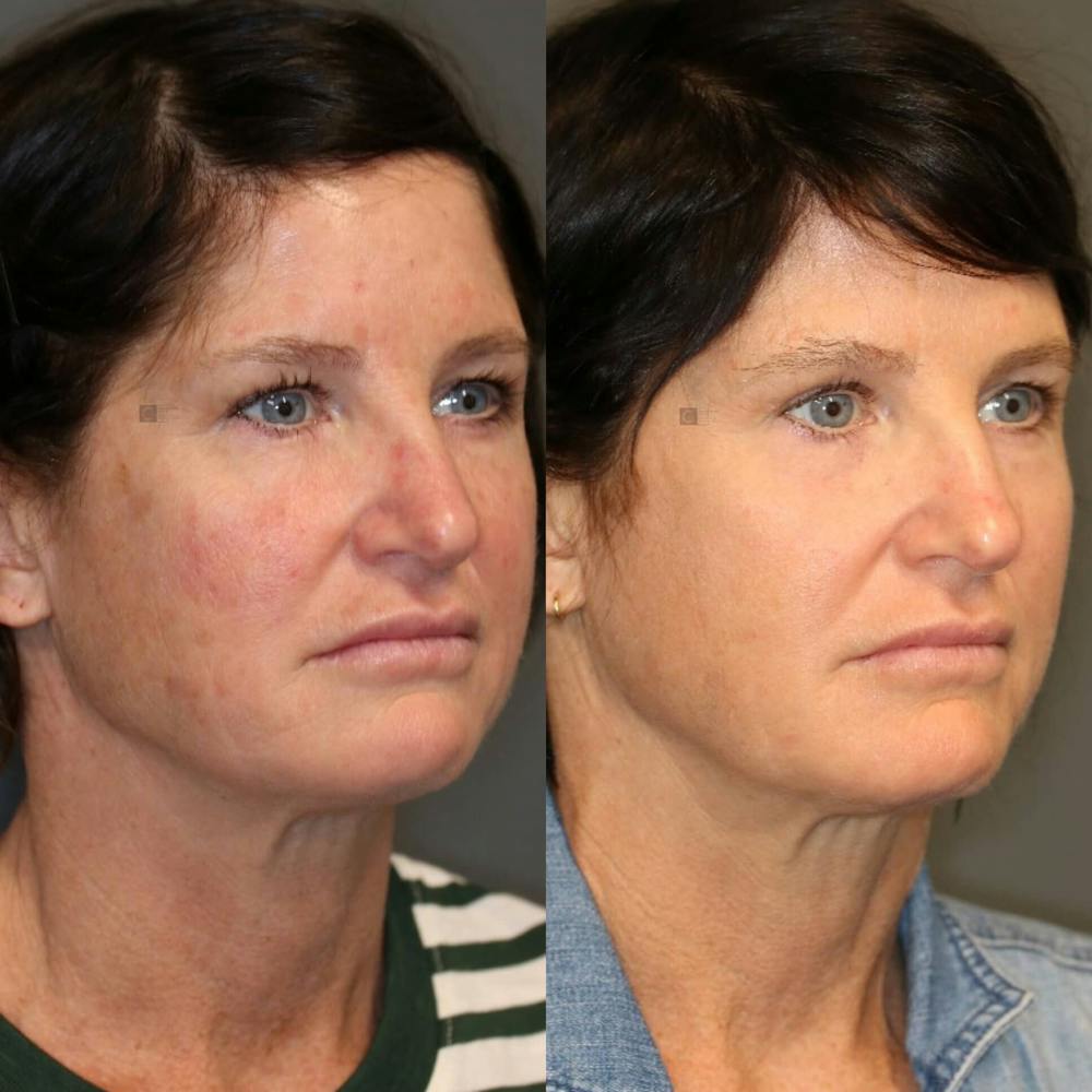 ÔPTIMized Laser Cocktail Before & After Gallery - Patient 116727569 - Image 2