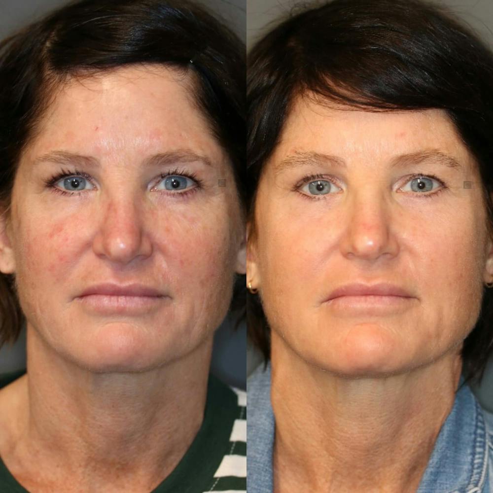 ÔPTIMized Laser Cocktail Before & After Gallery - Patient 116727569 - Image 3