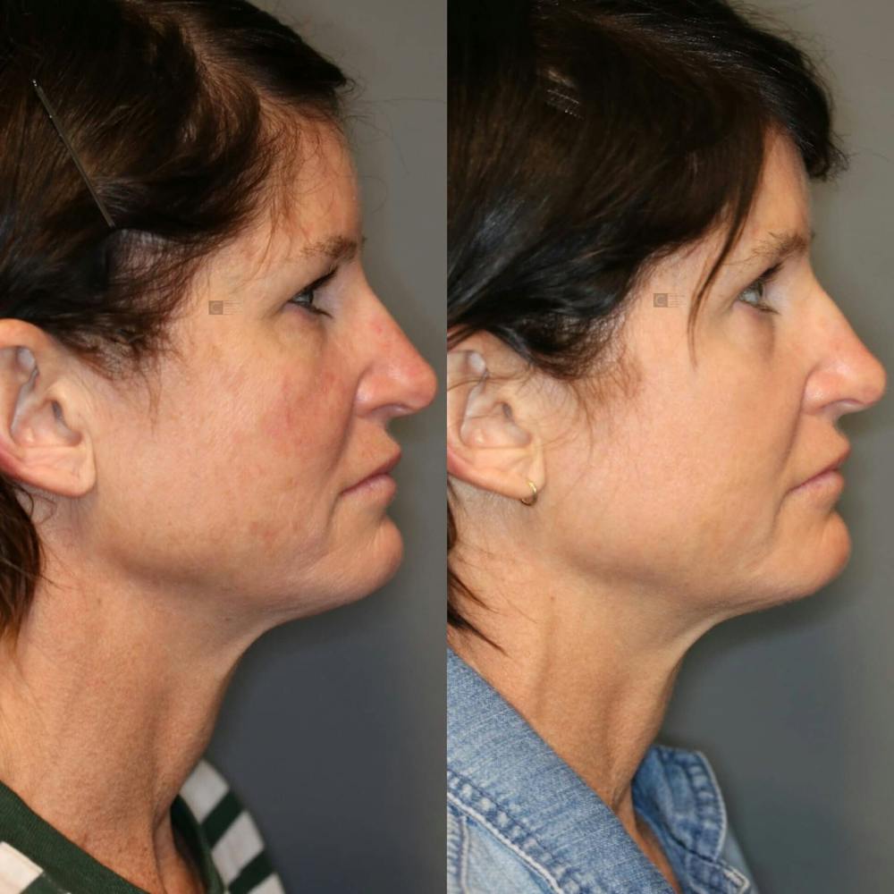 ÔPTIMized Laser Cocktail Before & After Gallery - Patient 116727569 - Image 4