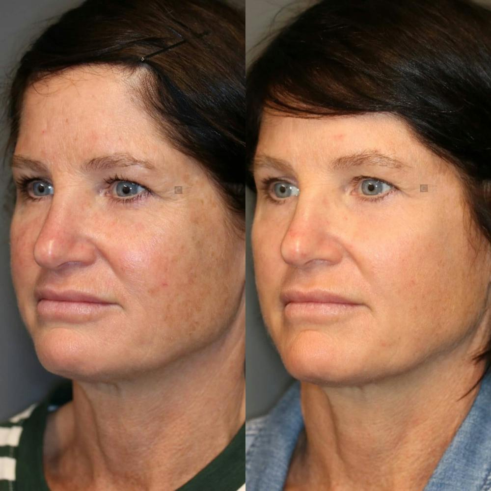 ÔPTIMized Laser Cocktail Before & After Gallery - Patient 116727569 - Image 5