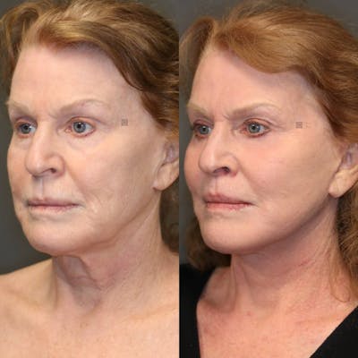 deep plane neck lift before and after picture