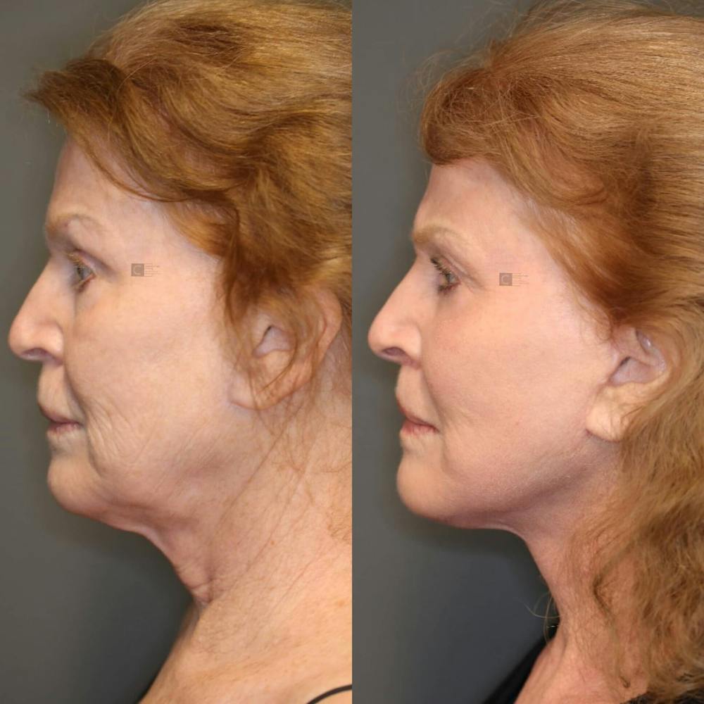Facial Fat Transfer Gallery - Patient 116730029 - Image 2