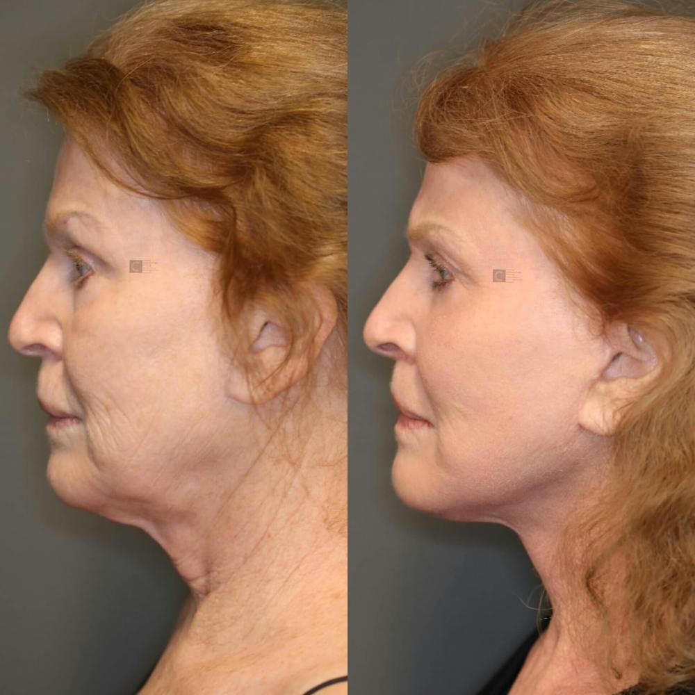 ÔPTIMized Facial Fat Transfer Before & After Gallery - Patient 116730029 - Image 2