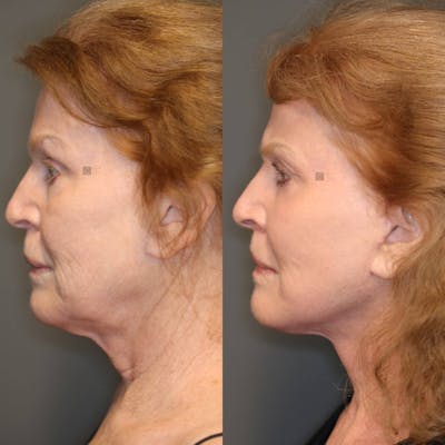LoveLift - Lip Lift Before & After Gallery - Patient 116730157 - Image 2