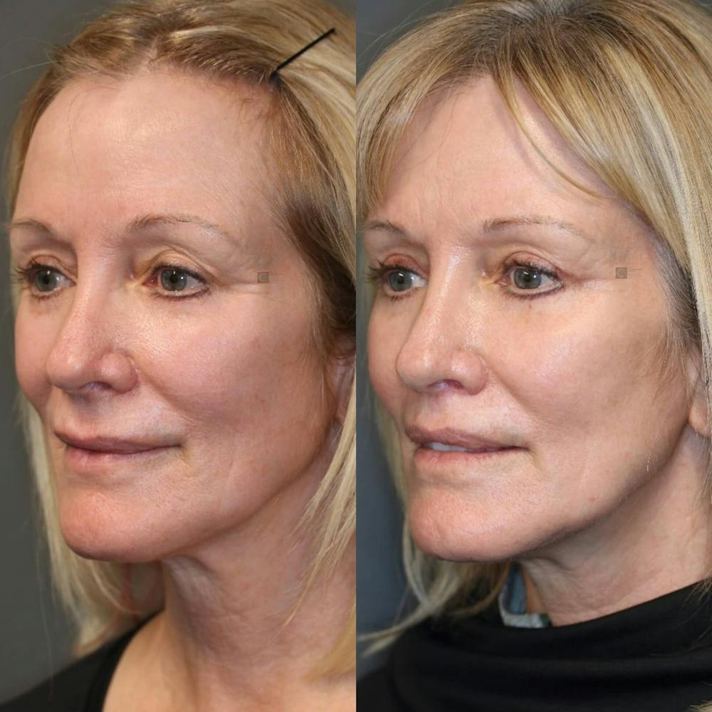 EnigmaLift - Brow Lift Before & After Gallery - Patient 116730829 - Image 2