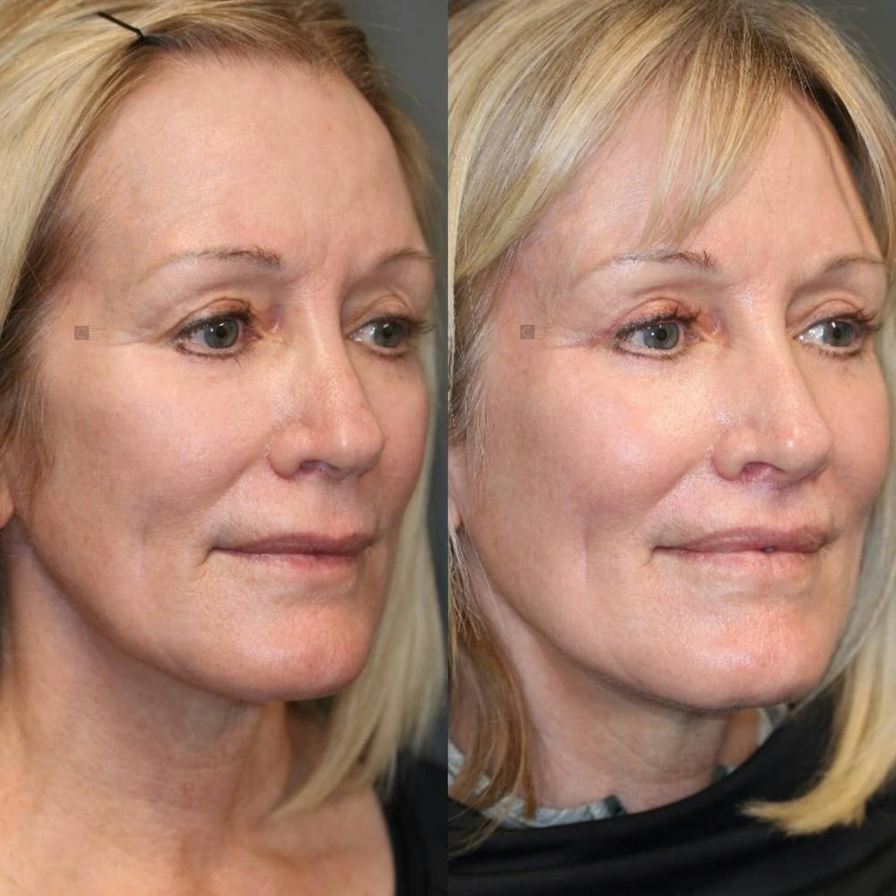 LoveLift - Lip Lift Before & After Gallery - Patient 116731109 - Image 1