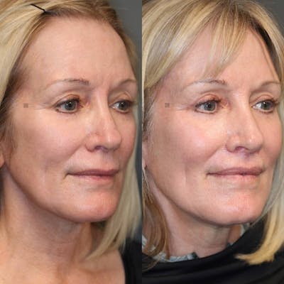 EnigmaLift - Brow Lift Gallery - Patient 116730829 - Image 1