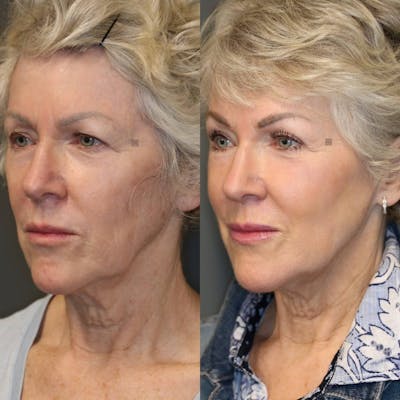 ÔPTIMized Facial Fat Transfer Before & After Gallery - Patient 116746617 - Image 2