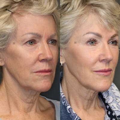 Before & After EnigmaLift Upper Eyelid Surgery