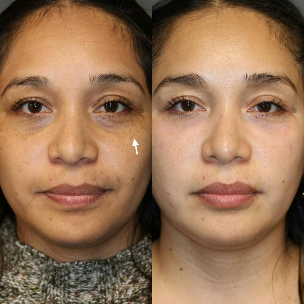 ÔPTIMized Facial Fat Transfer Before & After Gallery - Patient 116764446 - Image 1