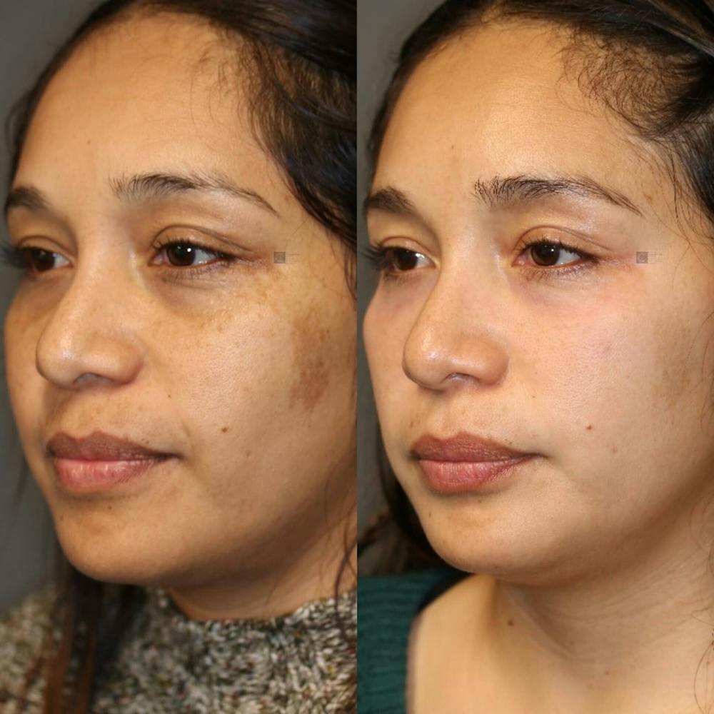 ÔPTIMized Laser Cocktail Before & After Gallery - Patient 116764500 - Image 2