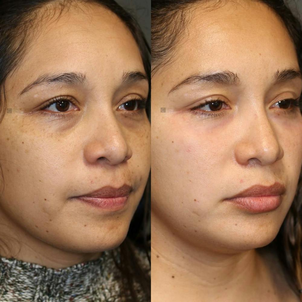 ÔPTIMized Facial Fat Transfer Before & After Gallery - Patient 116764446 - Image 3