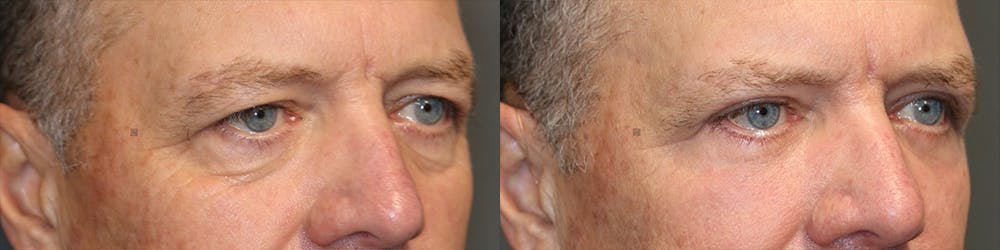 EnigmaLift - Eye Bag Removal Before & After Gallery - Patient 116764930 - Image 1