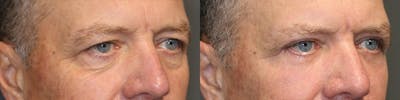  EnigmaLift - Upper Eyelid Surgery Before & After Gallery - Patient 116765062 - Image 1