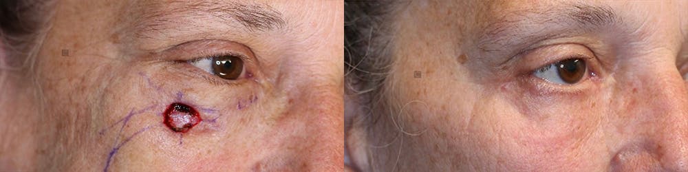 MOHS & Reconstruction Surgery Before & After Gallery - Patient 116765642 - Image 1