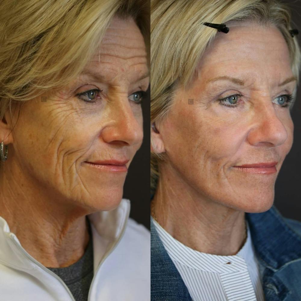 EnigmaLift - Brow Lift Before & After Gallery - Patient 116766247 - Image 2