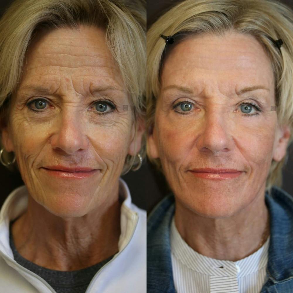 facelift before and after picture
