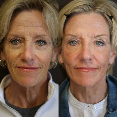 facelift before and after picture